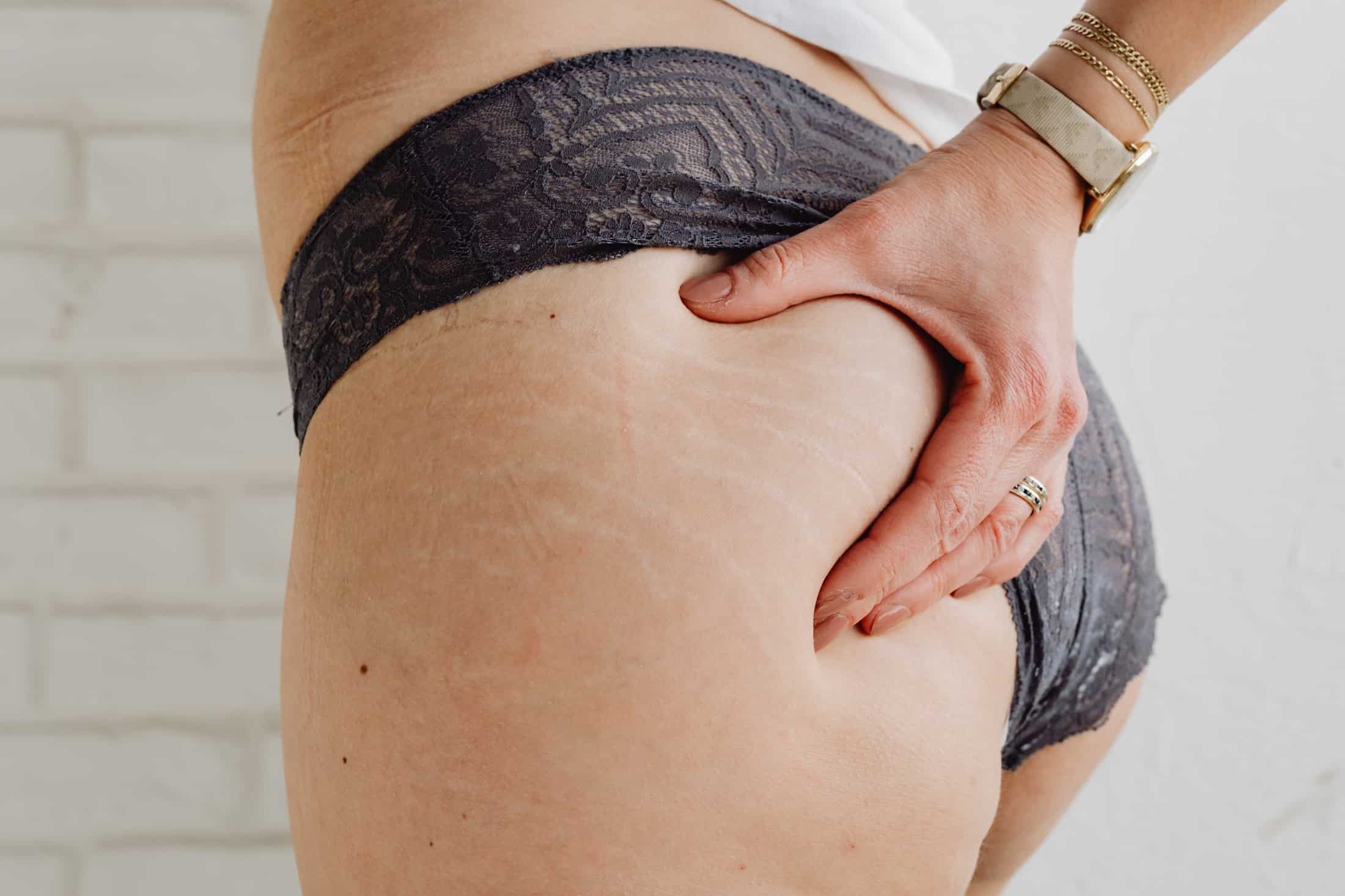 Stretch marks – why do they appear and how to fight them?